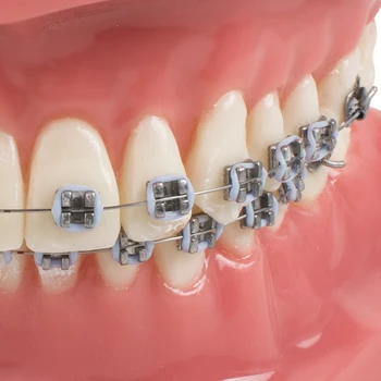Zobni Zob Študija Ortodontskega Rdeče Model s Kovinski in Keramični Oklepajih Ustni Dokazuje, Modeli