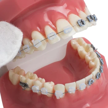 Zobni Zob Študija Ortodontskega Rdeče Model s Kovinski in Keramični Oklepajih Ustni Dokazuje, Modeli